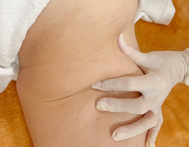 VelaShape III เชียงใหม่